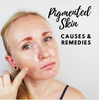 Pigmented Skin - Causes and Natural Therapies